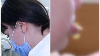 У Дніпрі 14-річна школярка самостійно збільшила собі губи: ледь не позбулася частини обличчя