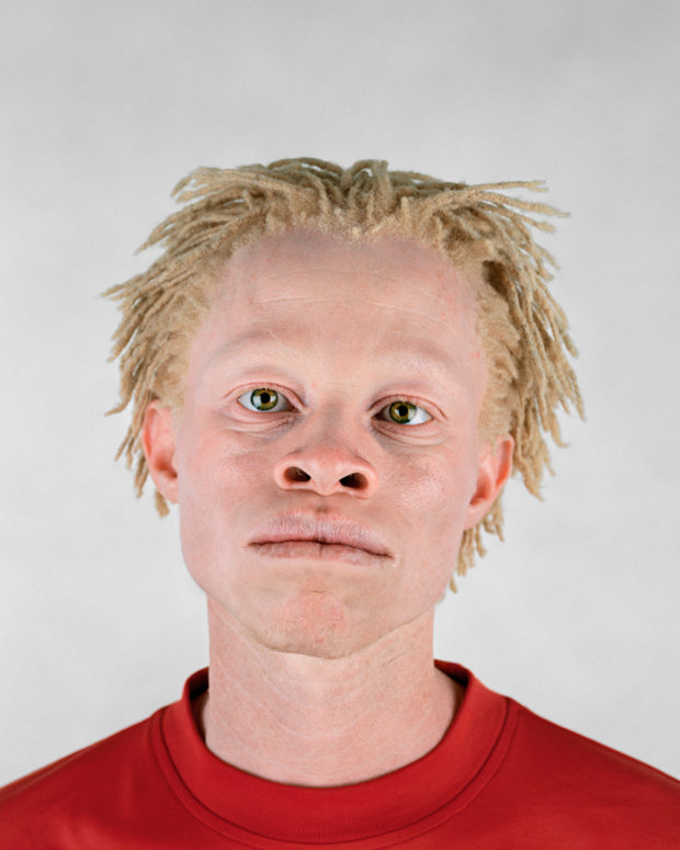 Африканец-альбинос