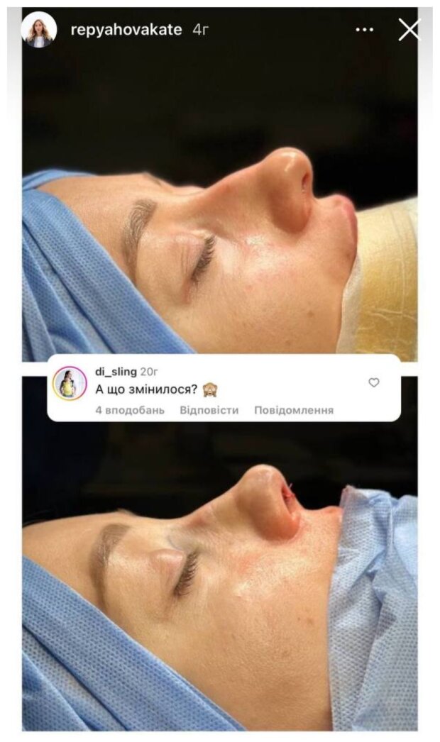 Катерина Репяхова до і після ринопластики