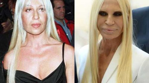 Как пластика Донателлы Версаче изуродовала ее лицо: фото до и после