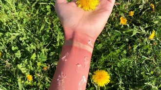 Никакого масла и сметаны: медики назвали правила первой помощи при солнечных ожогах