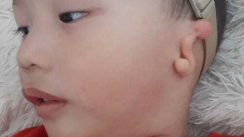 Найден мальчик, который родился без ушных отверстий (ФОТО)
