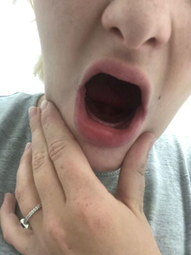 Девушка потеряла все зубы из-за редкого осложнения во время беременности