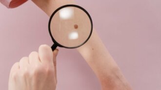 Как самостоятельно обнаружить меланому кожи: ответ дерматоонколога