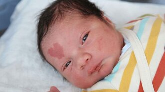 Ребенок с родимым пятном в форме сердечка