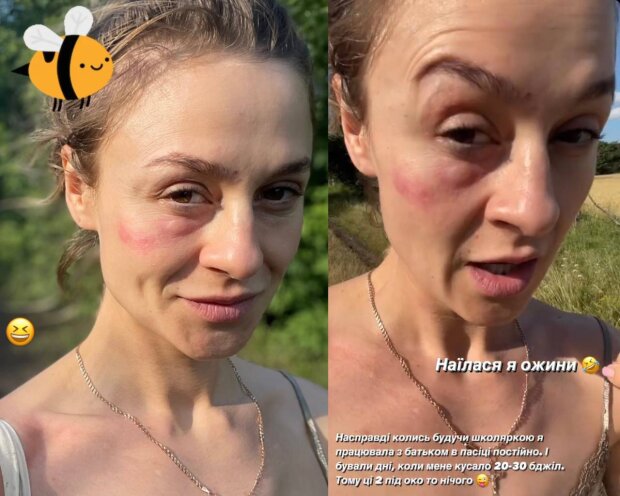 Ольга Мартиновська після укусу бджіл