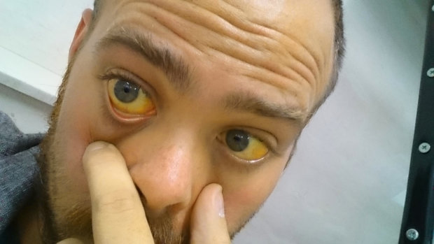 Желтизна глаз и кожи являются поводом немедленного обращения к врачу