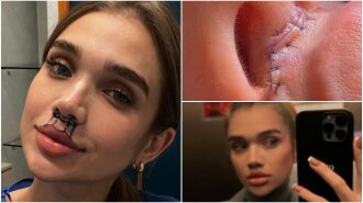 "Що за гіалуроновий вареник": Саша Бо показала, як робила операцію з виправлення форми губ – шви знімав чоловік