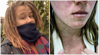 "Сдирала кожу с лица кусками": жуткая история украинки, которая в 21 год заболела корью