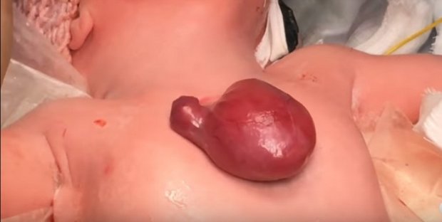 Вот так выглядело сердце девочки до операции