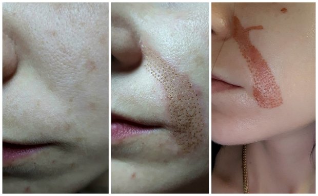 Ожоги на лице у девушки после процедуры «омоложение плазмой» (фото «Комсомольская правда»)
