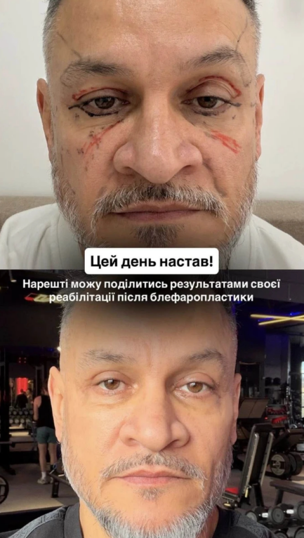 Эктор Хименес-Браво сделал пластическую операцию