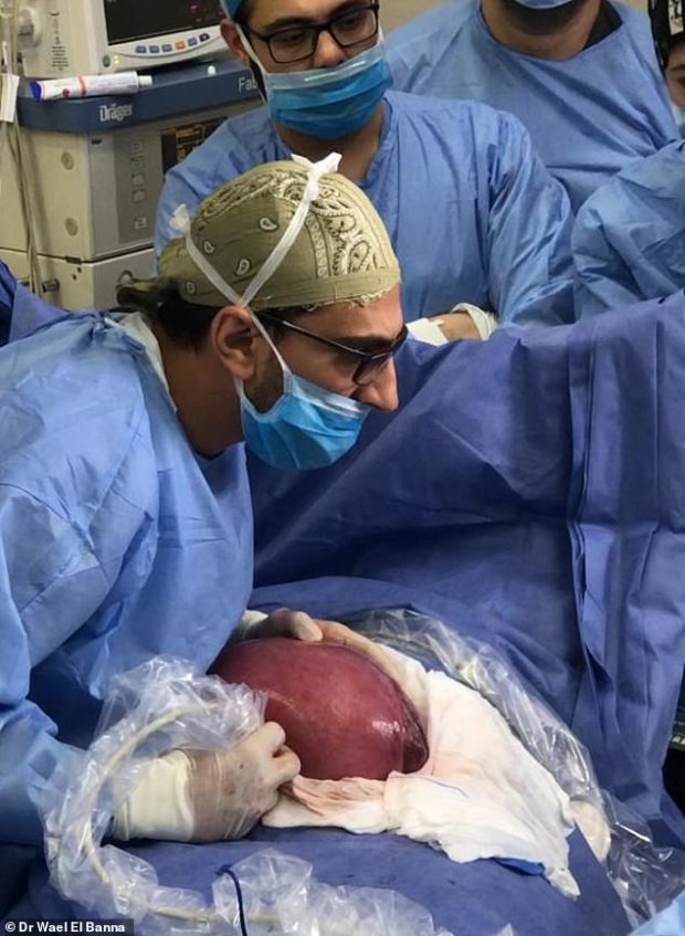 Хирурги достают матку с ребенком из тела женщины