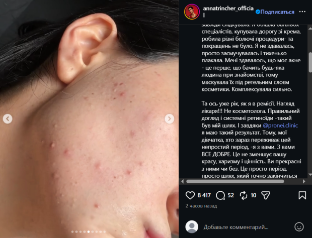 Анна Трінчер без макіяжу