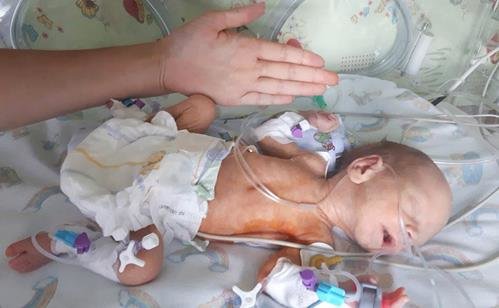 Ребенок с врожденным пороком сердца был прооперирован врачами из Института сердца МОЗ Украины (фото 