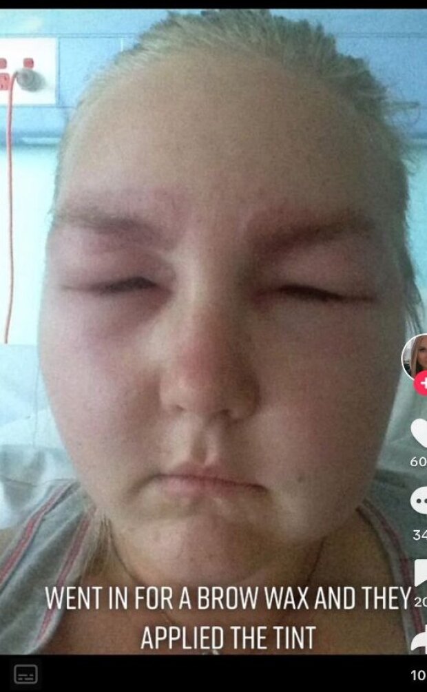 Похожа на инопланетянку: девушка ошарашила аллергической реакцией на краску для бровей