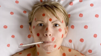 woman with red spots on face and body