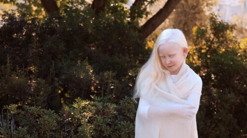 5 необычных фотографий альбиносов: уникальная подборка