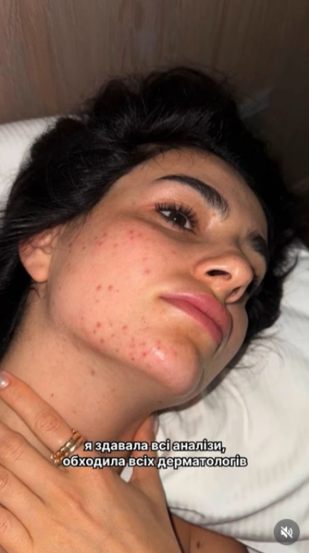Анна Трінчер без макіяжу про проблемну шкіру