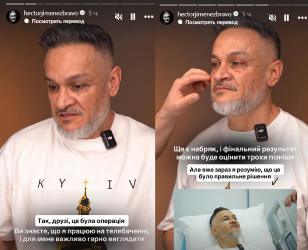 Эктор Хименес-Браво сделал пластическую операцию