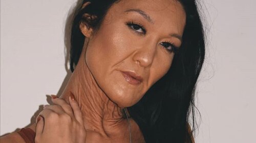 Сара Герц-29-річна дівчина з тілом Старої: Модель прославилася через жахливе захворювання шкіри (ФОТО)