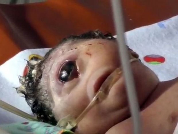 В Индонезии родился уникальный ребенок-циклоп: фото