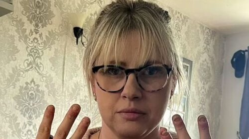 "Боялася втратити пальці": жінка показала, що стало з її руками після алергії на гель-лак (ФОТО)