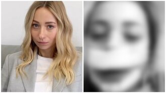 "Плачу від щастя": молода дружина Павлика зробила операцію на носі та показала обличчя у бинтах - фото з лікарні