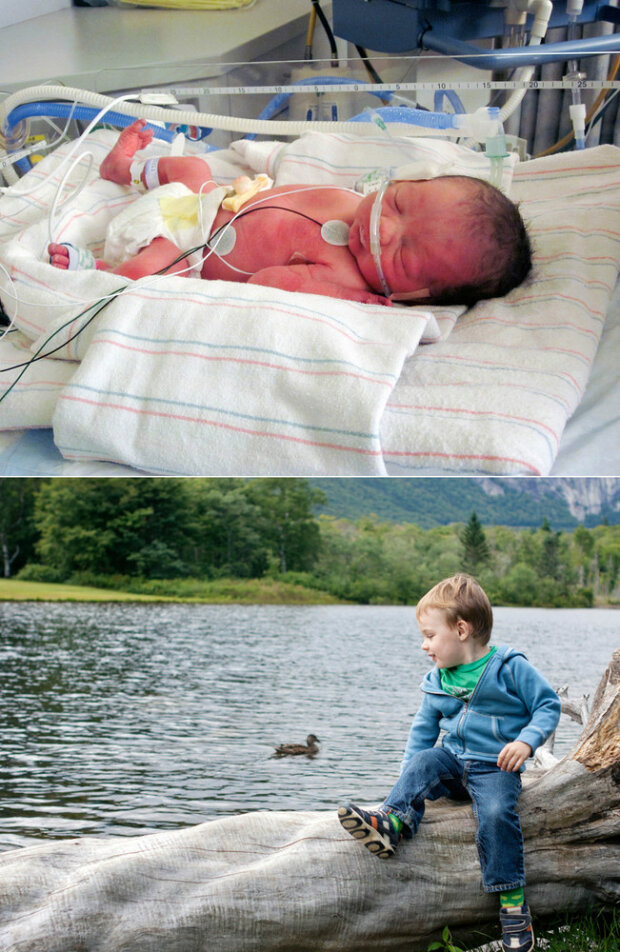 недоношенные дети, фото, до и после