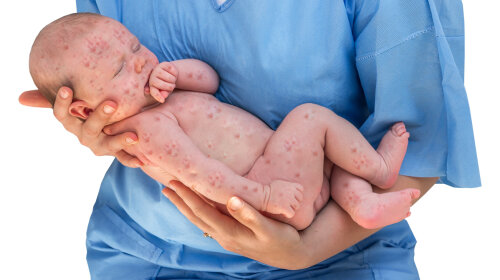 Doctor holding a newborn baby which is sick rubella