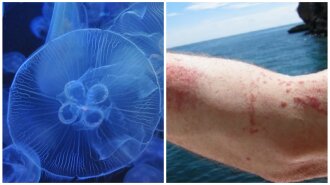 Никакого льда: медики рассказали, что делать, если ужалила медуза