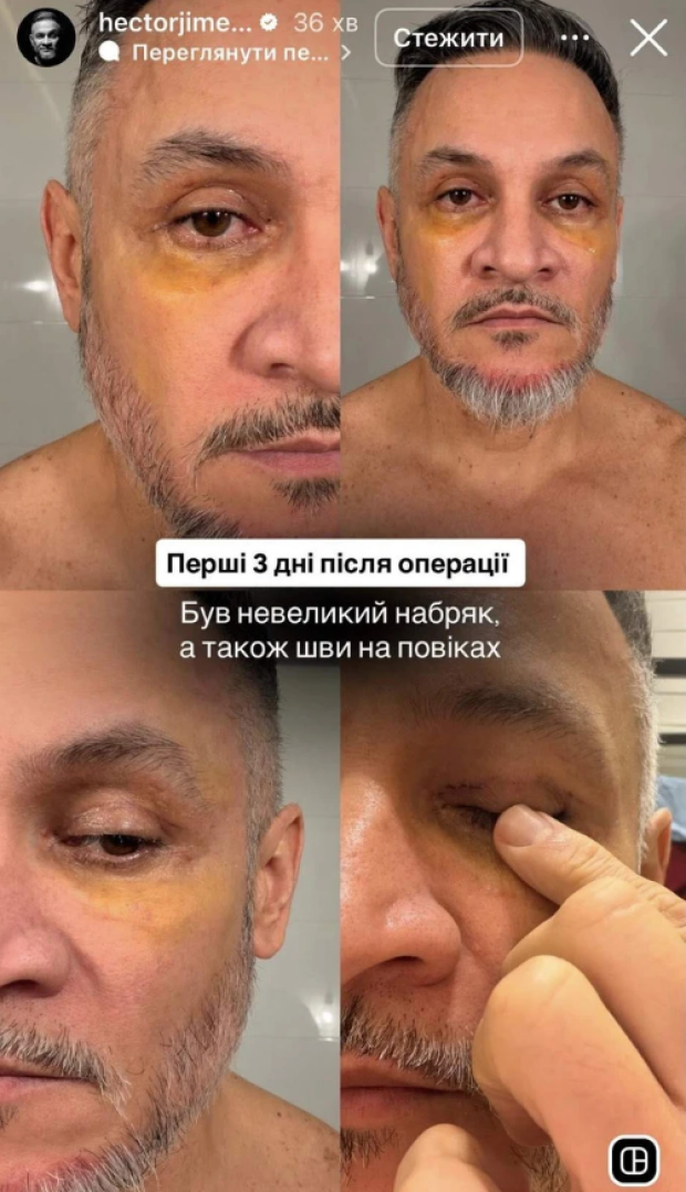 Эктор Хименес-Браво сделал пластическую операцию