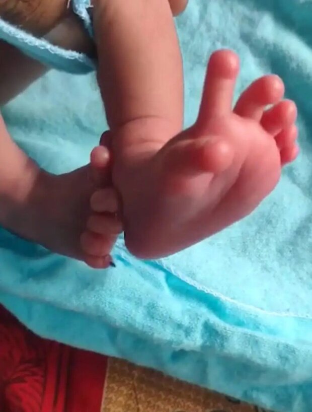"Реинкарнация богини": девочка родилась с 26 пальцами (ФОТО)