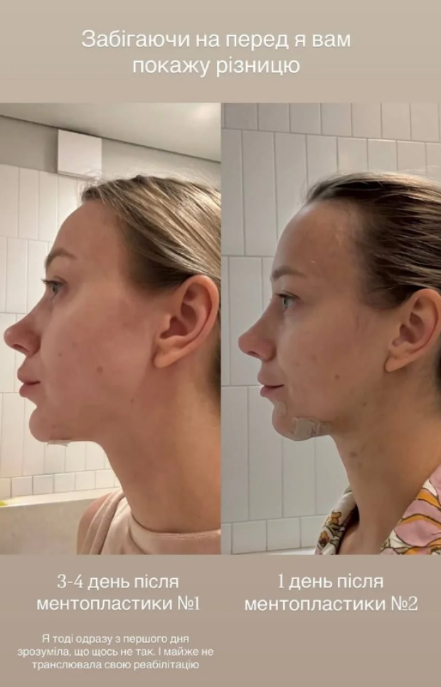 Катя Репяхова "до" та "після" пластичної операції