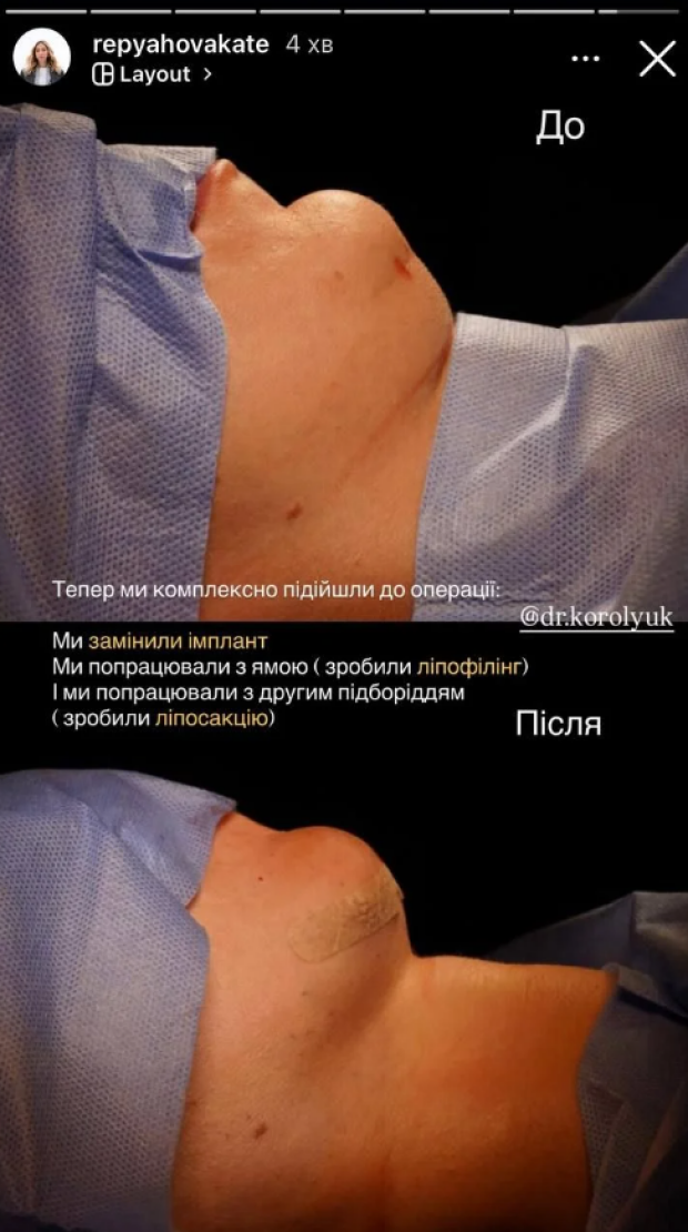 Катя Репяхова "до" та "після" пластичної операції