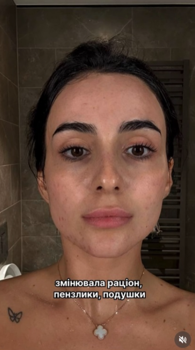 Анна Трінчер без макіяжу про проблемну шкіру