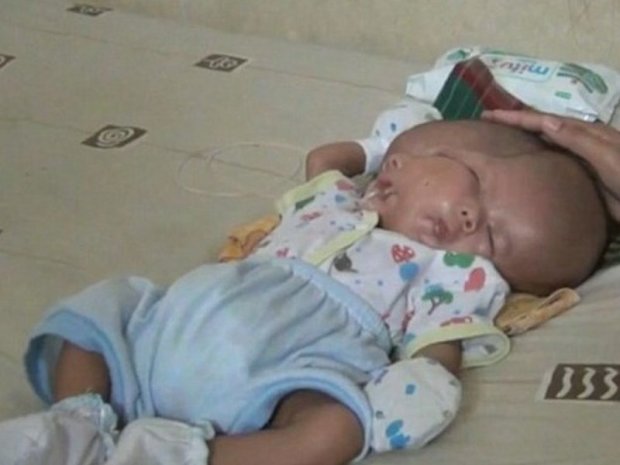 В Индонезии родился ребенок с двумя лицами (фото)