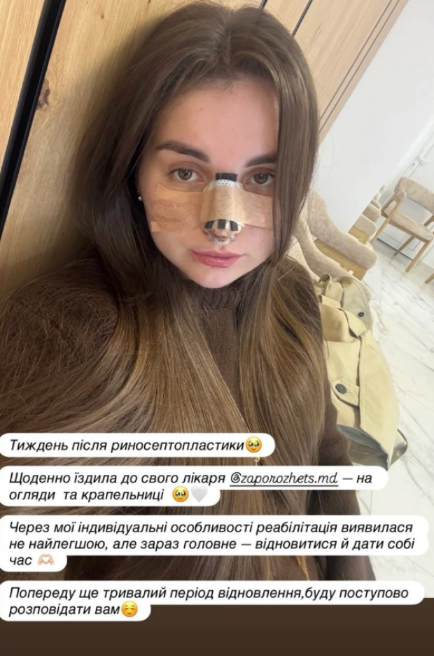 Донька Кузьми Скрябіна Барбара зробила пластичну операцію