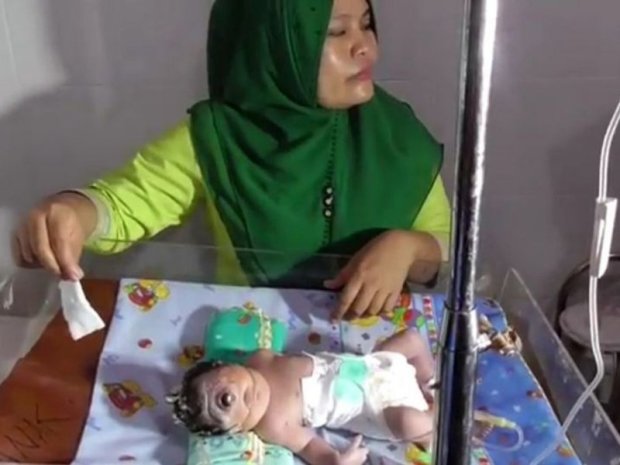 В Индонезии родился уникальный ребенок-циклоп: фото