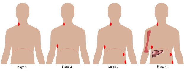 Четыре стадии лимфомы