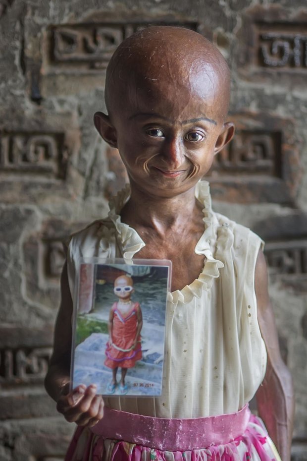 Таклима Ниту — девочка с очень редким генетическим заболеванием