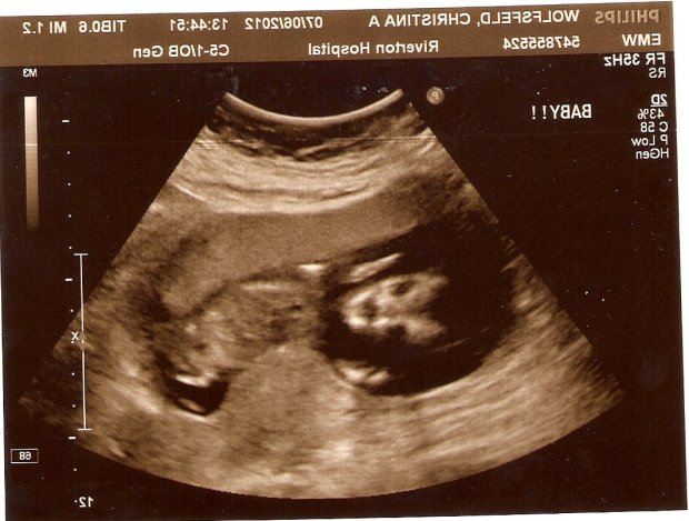 Снимок УЗИ 8 неделя беременности