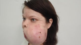У Вікторії величезна пухлина на обличчі і їй необхідна операція — допомогти може кожен