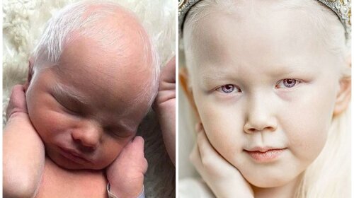 Уникальная красота: почему появляются дети-альбиносы и как они выглядят (ФОТО)
