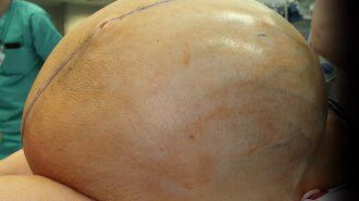 132-pound-ovarian-tumor-1525450271