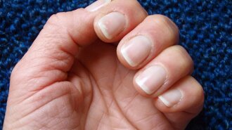 О каких заболеваниях расскажут ногти на руках и ногах: ломкость, пожелтение и не только