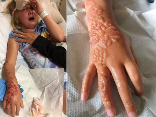 Контактный дерматит у ребенка после нанесения татуировки хной: Мэддисон и ее мама сделали тату во вр