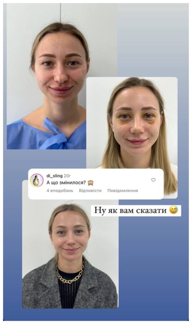Екатерина Репяхова до и после ринопластики