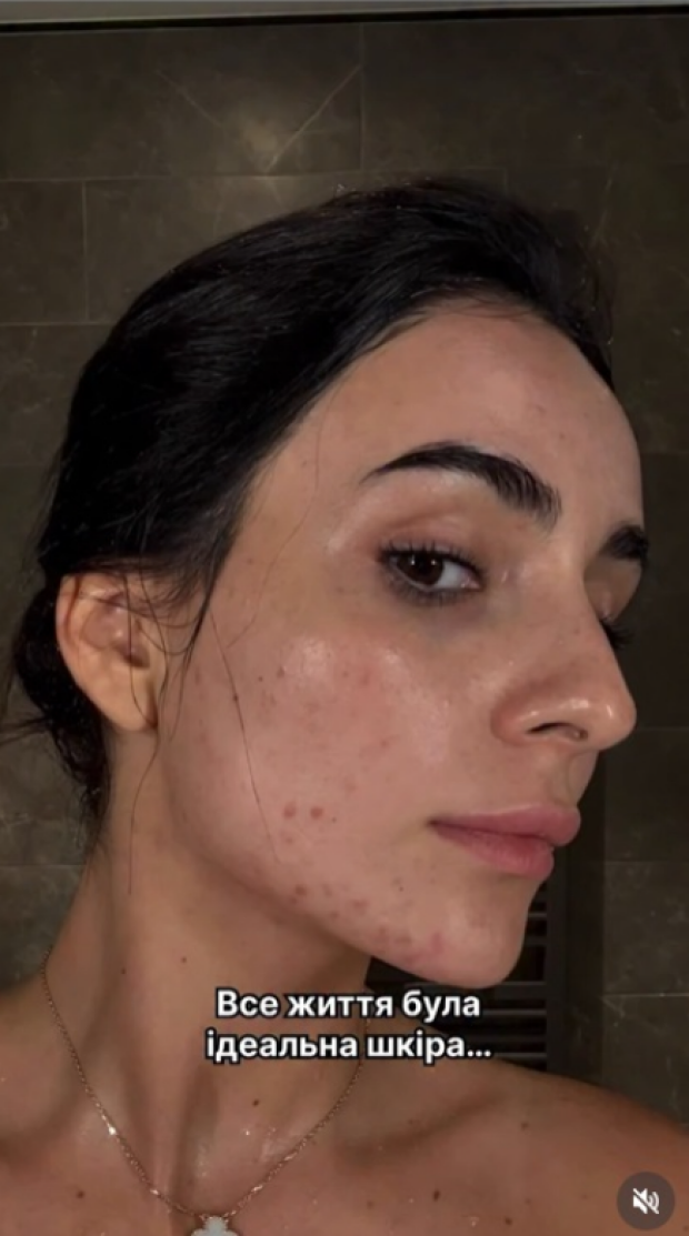 Анна Трінчер без макіяжу про проблемну шкіру