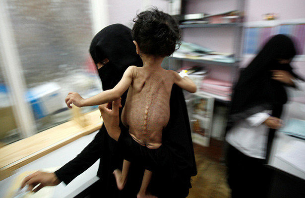 Голод в Йемене коснулся почти каждого ребенка